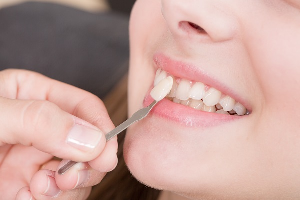 Services - Dental Veneers