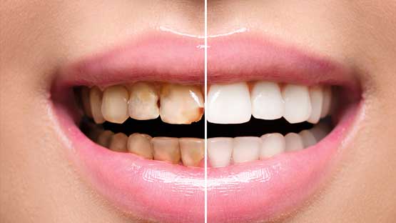 Full mouth rehabilitation with AO6 – screw retained PFM prosthesis