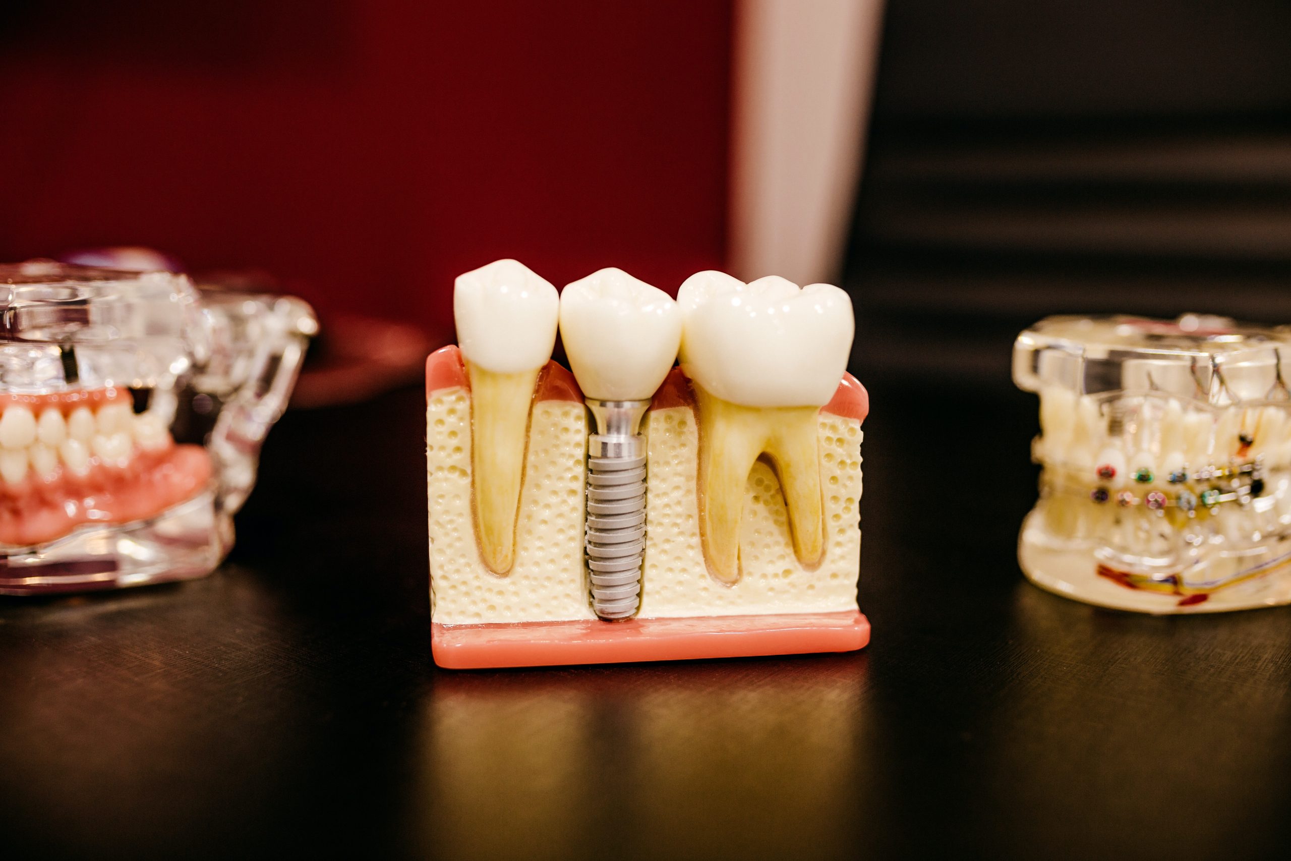 Services - Dental Implants