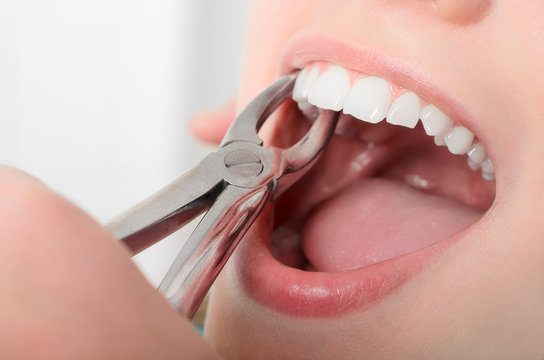 Painless Tooth Extraction