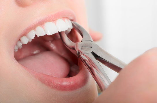 Painless Tooth Extraction