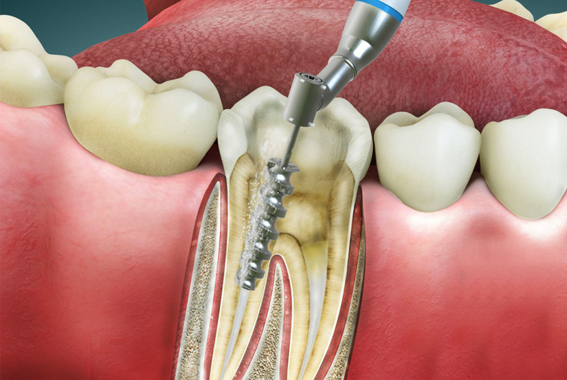 Painless Root Canal