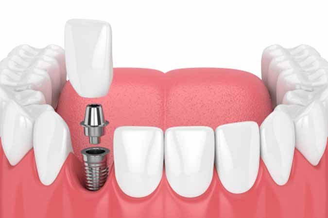Permanent teeth replacement without denture for a missing front tooth at Dr. Hileri Mori, Punawale, Pune.