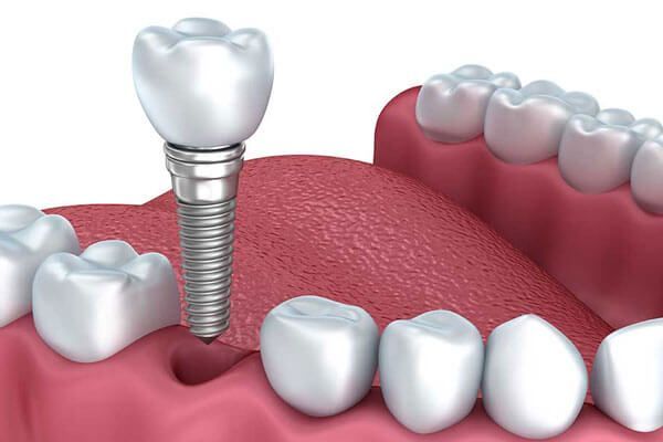 Dental implant procedure showing titanium implant and crown replacement at Dr. Hileri Mori in Punawale, Pune.